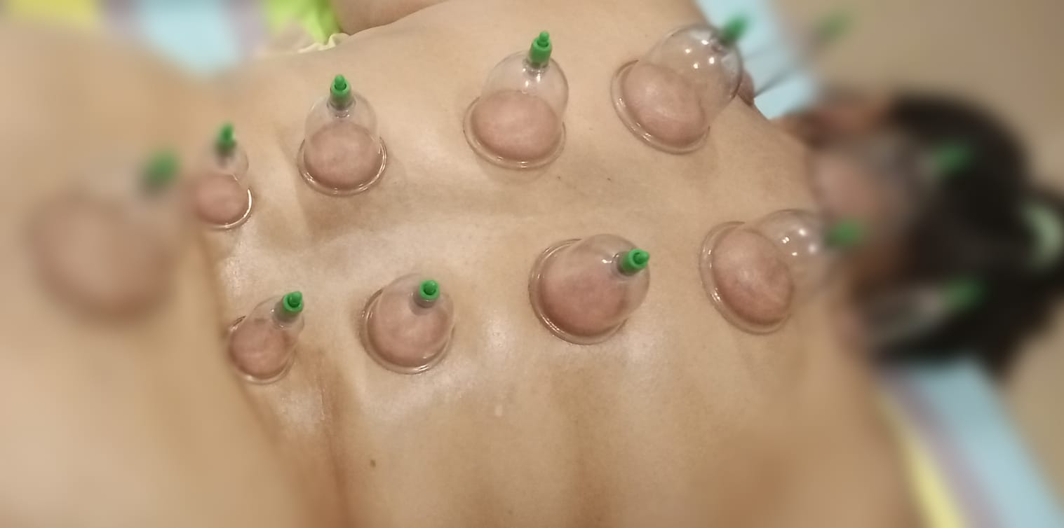 Hijama Therapy