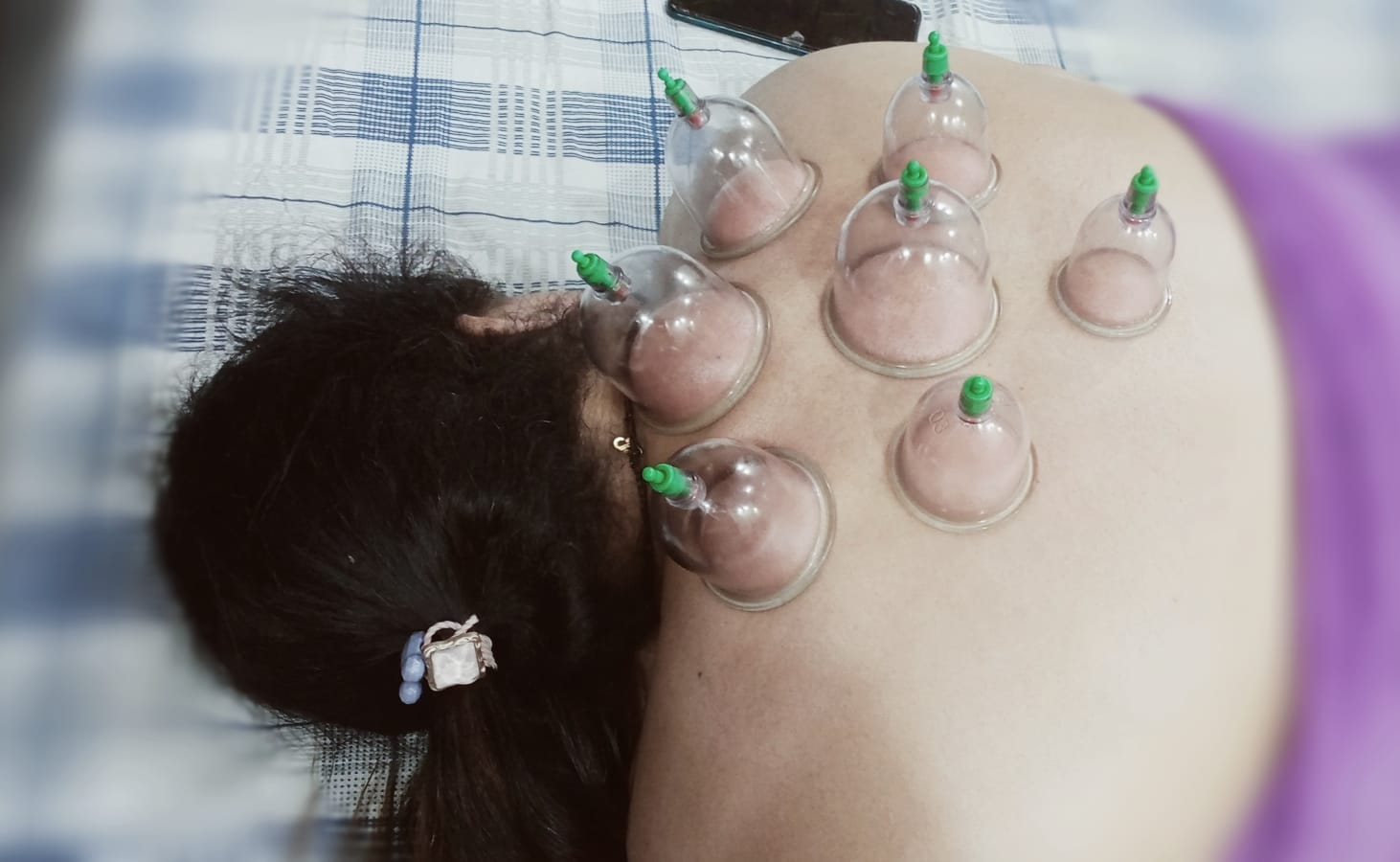 Cupping Therapy